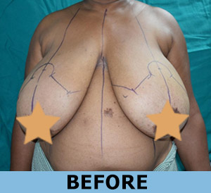 Breast Reduction Surgery in Delhi NCR, Surgery Cost